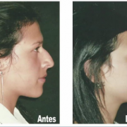 Plastica Facial Calvache cirugia estetica